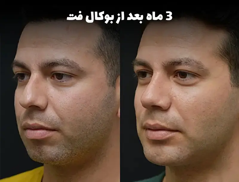 عکس یک آقای جوان، 3 ماه بعد از بوکال فت