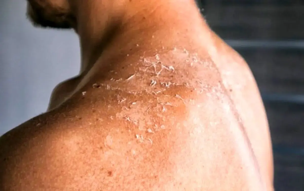 آفتاب سوختگی (4)