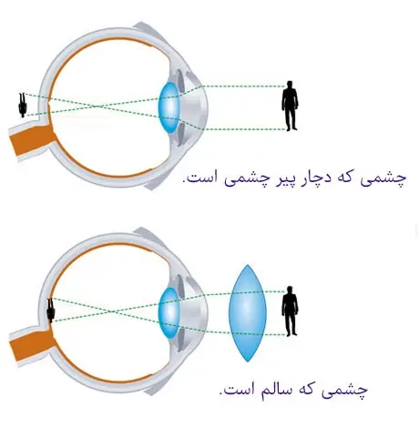 پیر چشمی