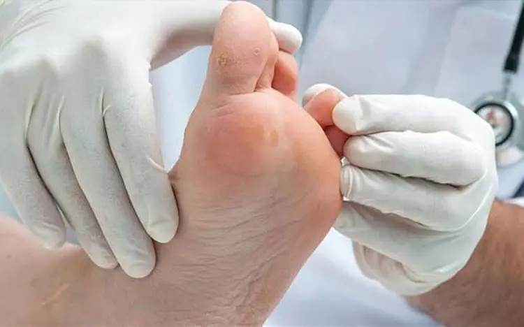زخم پای دیابیتی؛ علل، نشانه‌ها و راه‌های درمان آن