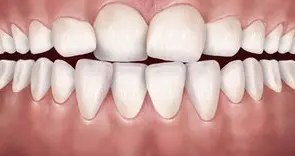 فضای کم دندانی