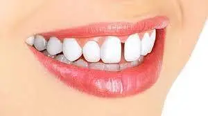 فضای بین دندانی