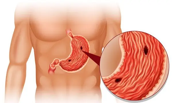 عجیب‌ترین علائم ابتلا به زخم معده؛ از مدفوع سیاه و آروغ زدن تا نفخ معده و استفراغ خونی