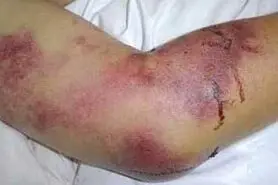 شناسایی یک مورد مشکوک به بیماری تب کنگو در شاهین‌شهر