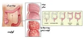 کولیت؛ لاعلاج یا صعب‌العلاج؟!
