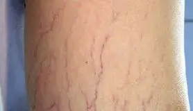 لخته های عروقی،عارضه شایع واریس