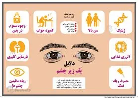 اینفوگرافی: دلایل پف زیر چشم
