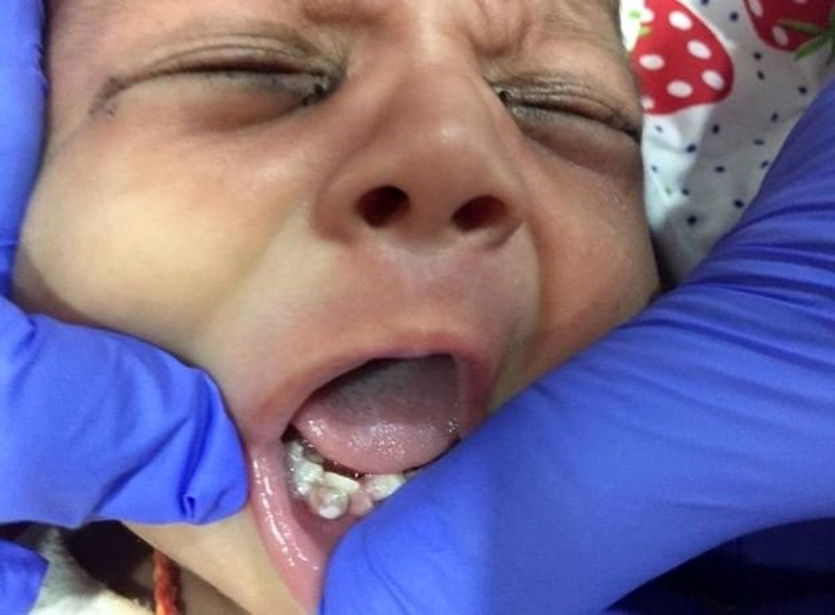 7 دندان نوزاد یکماهه هندی کشیده شد