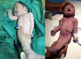 تولد نوازدی به شکل پری دریایی در هند !