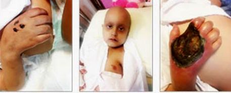 احتمال قطع دستان «علیرضا» 6 ساله درپی قصور پزشکی