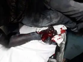 قطع دست نوجوان 16 ساله افغانی بر اثر  انفجار مواد محترقه