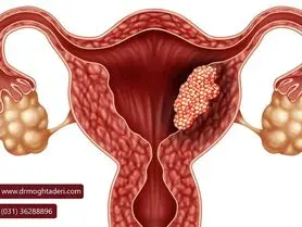 پیشگیری از سرطان دهانه رحم