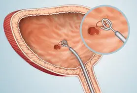 علت، علائم، تشخیص و درمان سرطان مثانه