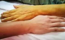 چرا رنگ پوستمان زرد می شود؟