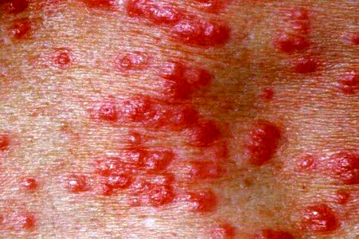 علائم پوستی بیماری کرونا چیست؟