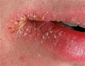 چرا گوشه لب‌ها ترک می‌خورد؟