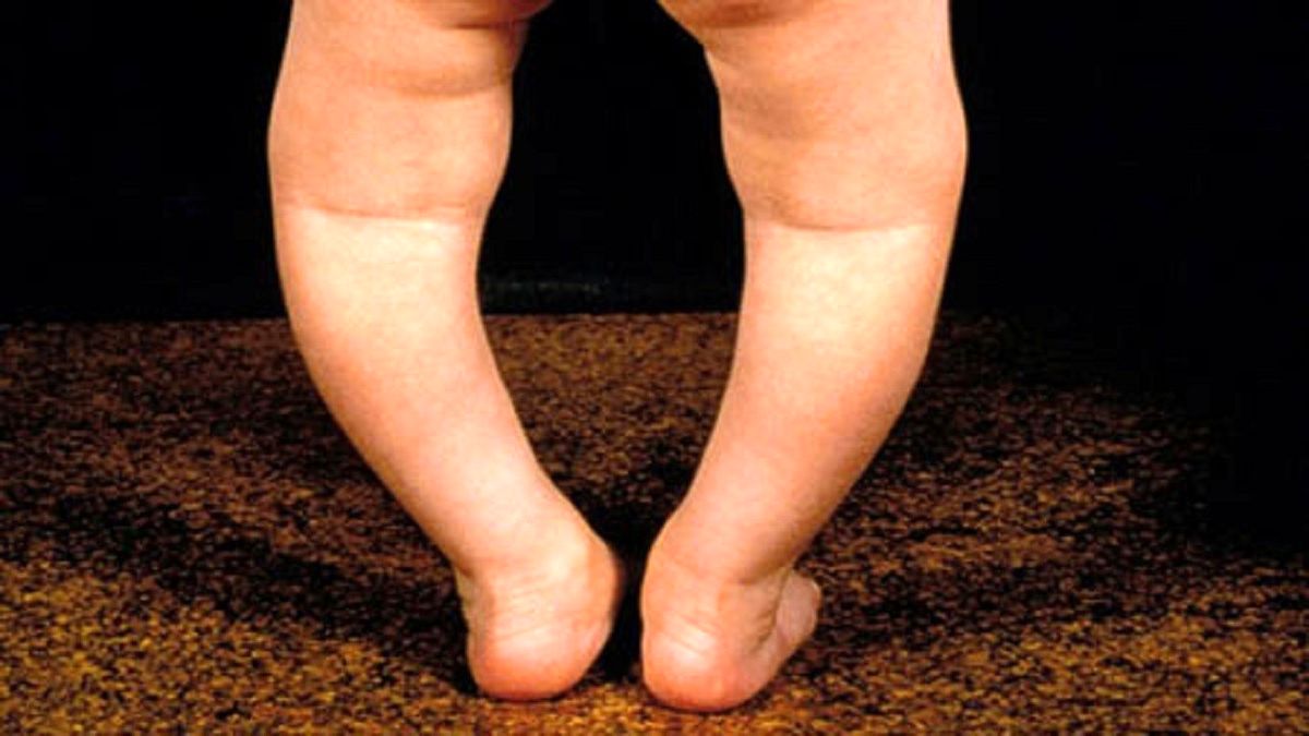 پای پرانتزی در کودکان قابل درمان است