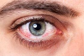 ۴ دلیل اصلی قرمزی چشم و درمان آن