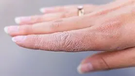 علل خشکی پوست و شیوه‌های درمان آن