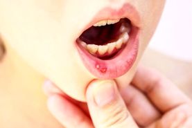 علت ، علائم و درمان سریع آفت دهان و زبان