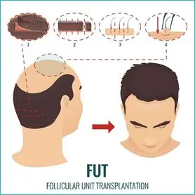 کاشت مو به روش FUT : مزایا ، عوارض جانبی ، نحوه کار