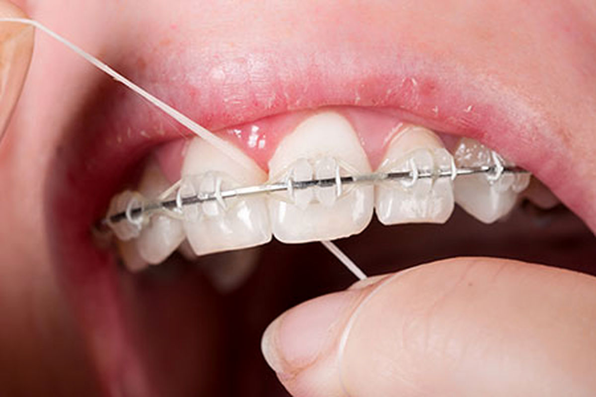 چگونه با ارتودنسی نخ دندان بکشیم؟