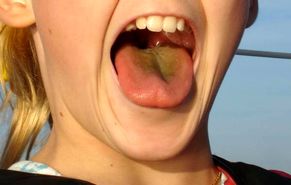 علل، عوارض و درمان خانگی زردی زبان
