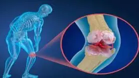 پوکی استخوان چه زمان در زنان شروع می‌شود؟