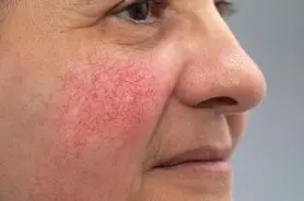 تغییرات پوستی که نشانه ای از بیماری کبد هستند