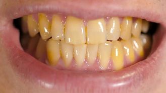 چرا دندان‌ها زرد می‌شوند؟