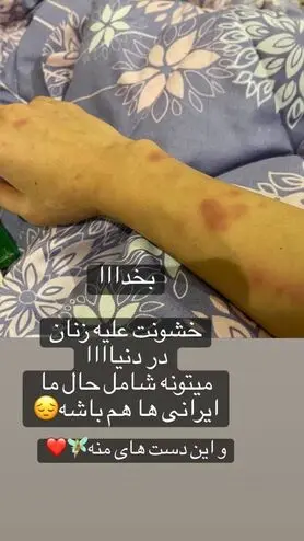 “نفیسه روشن” مورد ضرب و شتم و خشونت خانگی قرار گرفت! + عکس دست کبود وی