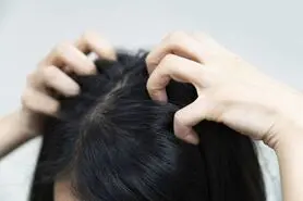 شوره سر چیست و چگونه به وجود می آید ؟