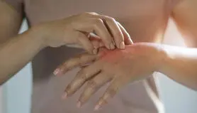 پورفیری چیست؟ علائم، علل، انواع، عوارض و درمان بیماری پورفیری را بشناسید